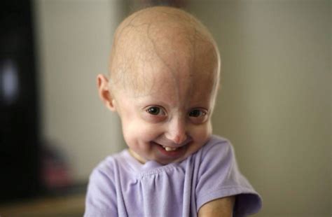 sindrome de progeria-1